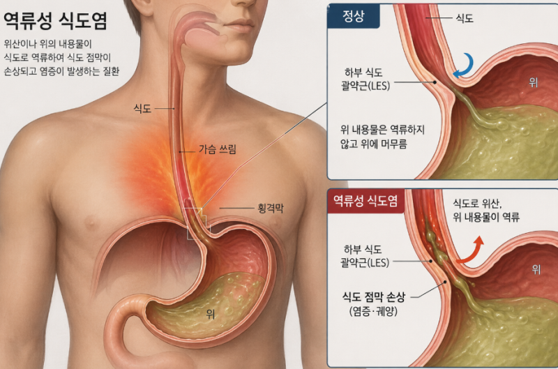 역류성 식도염에 좋은 음식, 속 쓰림 줄이는 식단 선택법