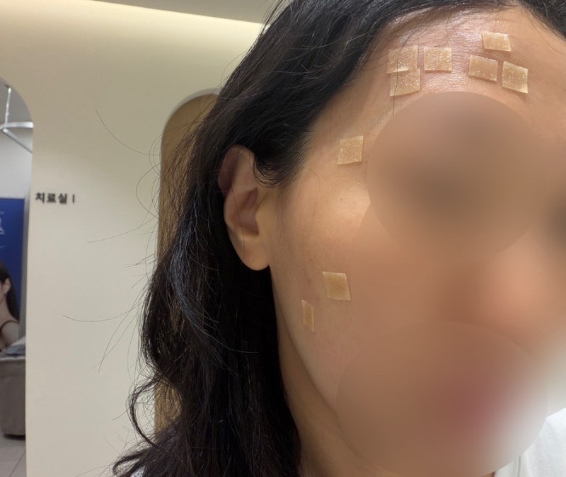 편평사마귀 제거 후 관리, 메디폼부터 화장까지 6일 기록