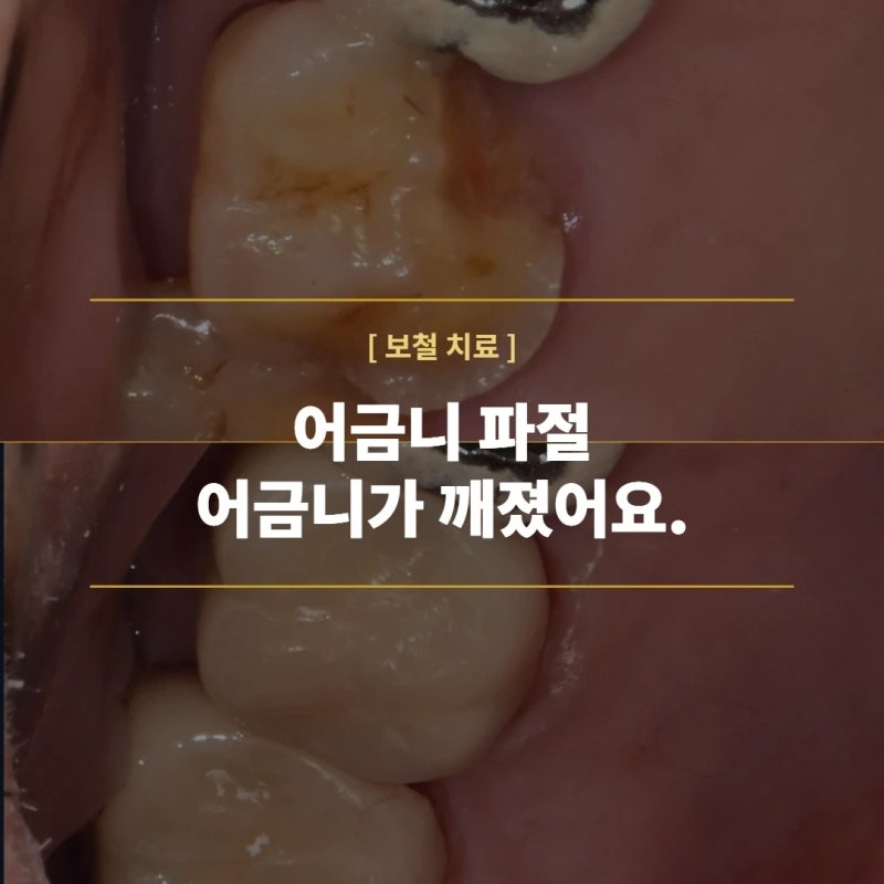 어금니 파절, 크라운 치료로 해결할 수 있습니다