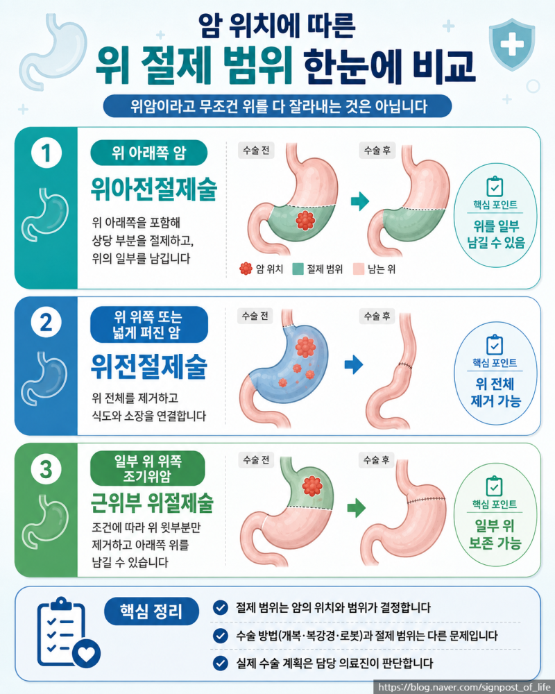 위암 수술하면 위를 다 잘라내나요?부분절제·전절제·복강경·로봇수술 차이