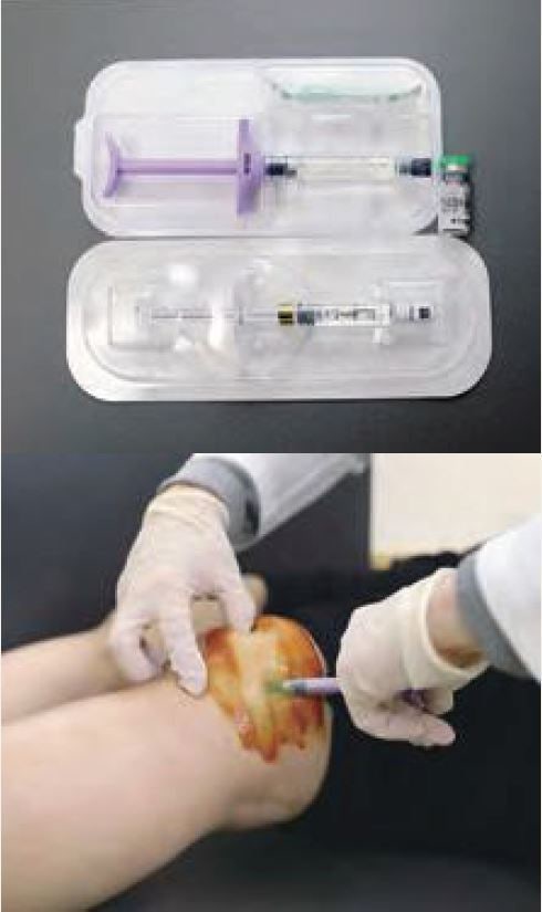 연골주사 효과 지속기간 비용 근력운동과 비교