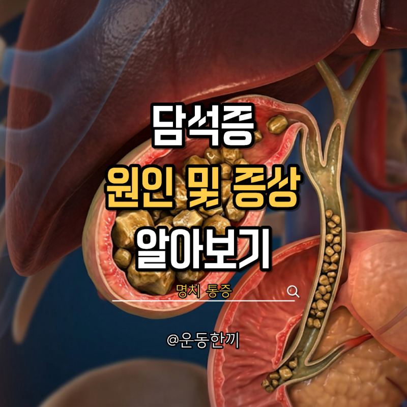 담석증 원인 증상 음식 스트레스 총정리