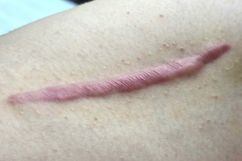 부산 피부과 켈로이드 흉터 피부 주사 치료 1회차 기록ㅣ통증 병원정보