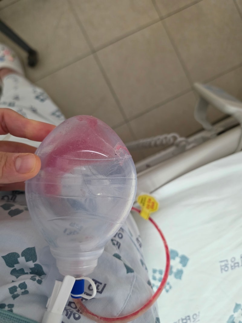 복강경담낭절제술, 급성담석증수술, 담낭제거후 식단, 회복기간 2