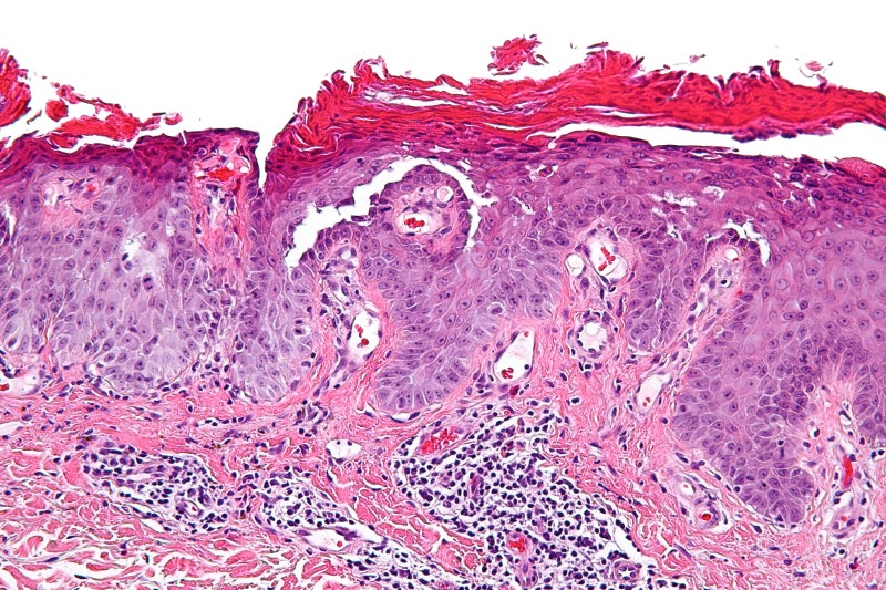 피부병 Skin disease/Dermatosis: 피부는 말 한마디보다 먼저 아팠습니다