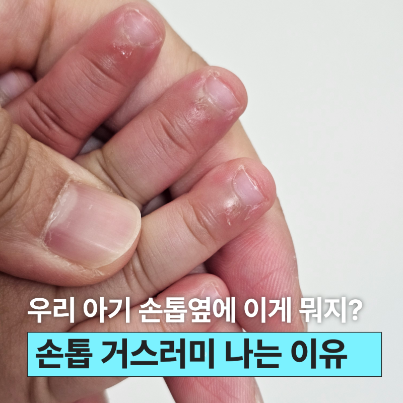 9개월 아기 손톱 옆이 자꾸 일어나요, 거스러미 생기는 이유는?