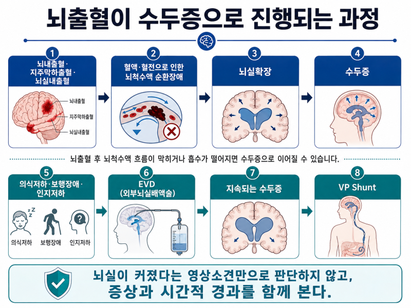 뇌출혈 후 수두증으로 션트 수술까지 했다면?_오늘의손사 서호석손해사정사