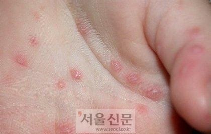 수족구 초기증상, 아기 발열부터 입안 수포까지 놓치면 안 되는 신호 정리