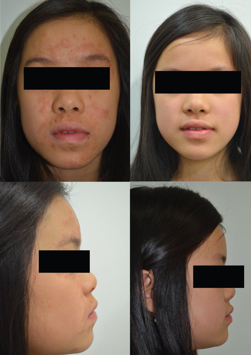 어린이 자반증 초기, 올바른 치료를 위해서는 ‘정확한 진단’이 필수