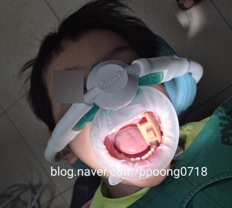양산부산대병원 소아치과 과잉치 발치 후기