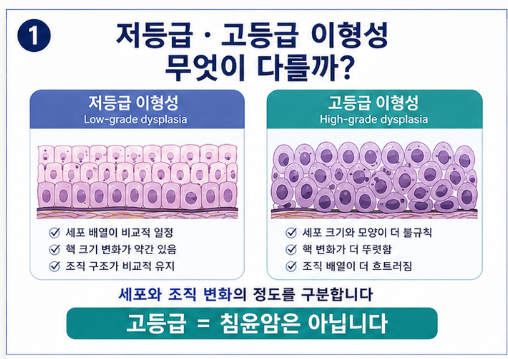 조직검사 결과 저등급·고등급 이형성이란? 암과 무엇이 다를까?
