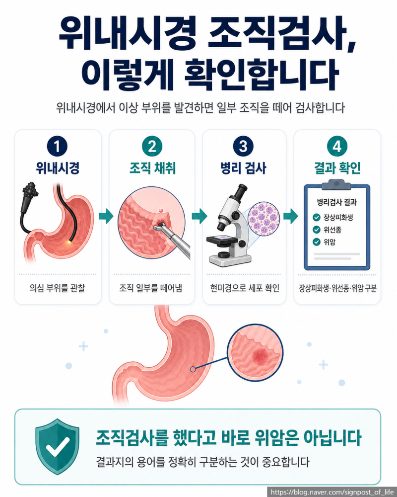 위내시경 조직검사 결과, 장상피화생·위선종이면 위암일까?
