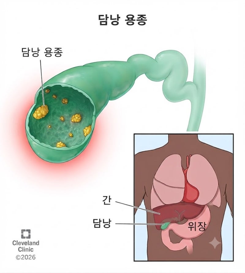 담낭용종 원인, 종류별로 정확히 알아보기
