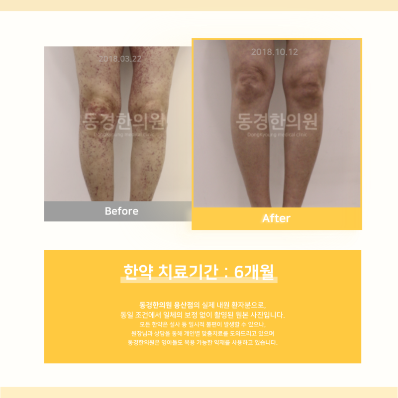 성인 자반증 치료를 앞두고 있다면 짚어봐야 할 것