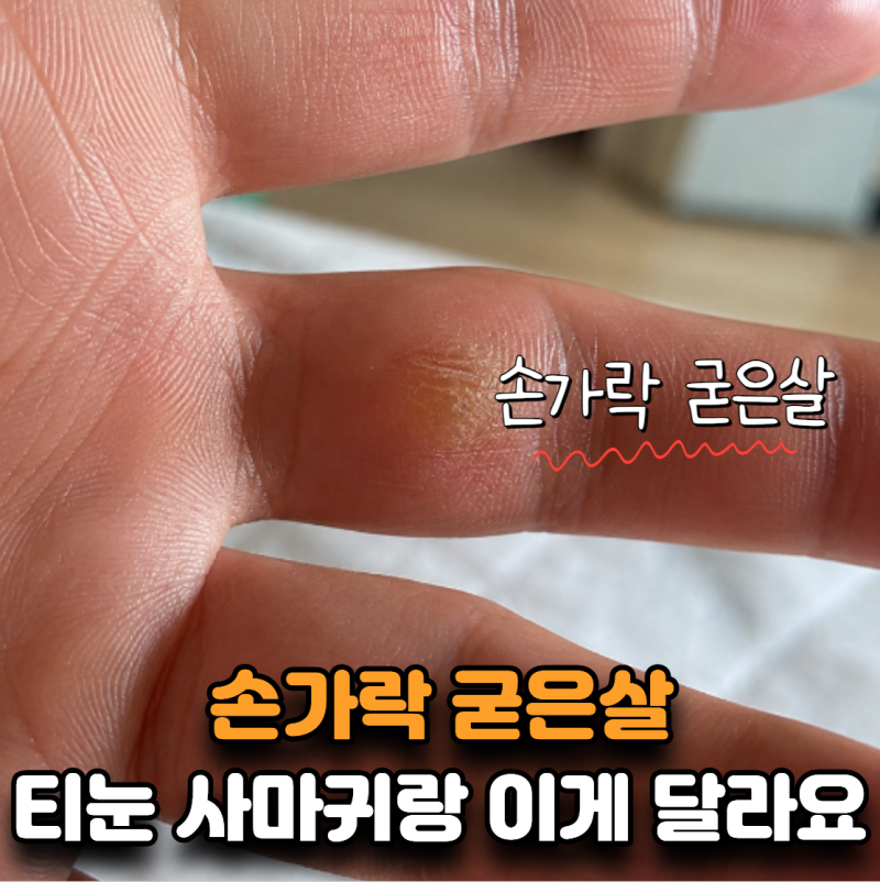 “굳은살인 줄 알고 뜯었는데…” 손가락 티눈·사마귀는 이렇게 달라요
