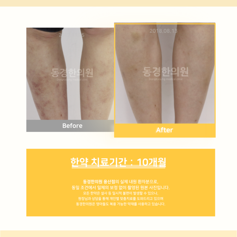 얼굴에 붉은반점? 간지러움까지 있다면 그냥 두지 마세요.