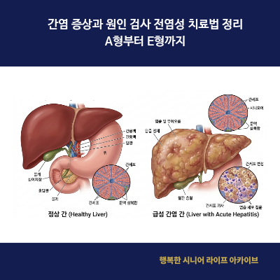 간염 증상과 원인 검사 전염성 치료법 정리｜A형부터 E형까지