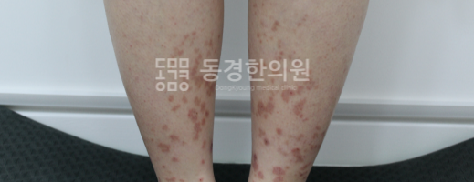혈관염 두드러기 치료를 위해 알아두어야 하는 것