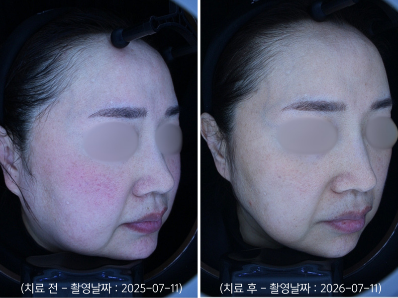 영등포 홍조치료, 안면홍조 레이저 받으면 붉은기가 좋아지나요?