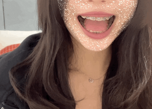 [성인 치아교정 후기] 치아교정 시작~6개월 차까지 메탈교정의 모든 것 1편 내돈내산교정일기