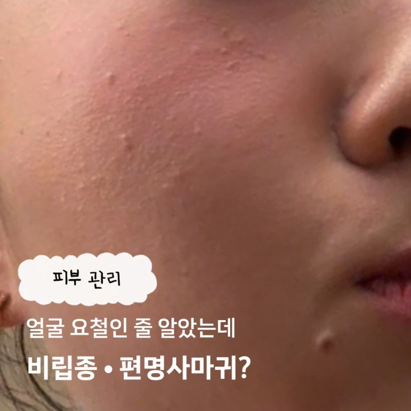 얼굴 요철인 줄 알았는데 비립종·편평사마귀? 차이점과 제거 방법