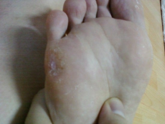 당뇨 초기증상 피부 가려움과 발저림, 증상 없다고 안심하면 안 되는 이유