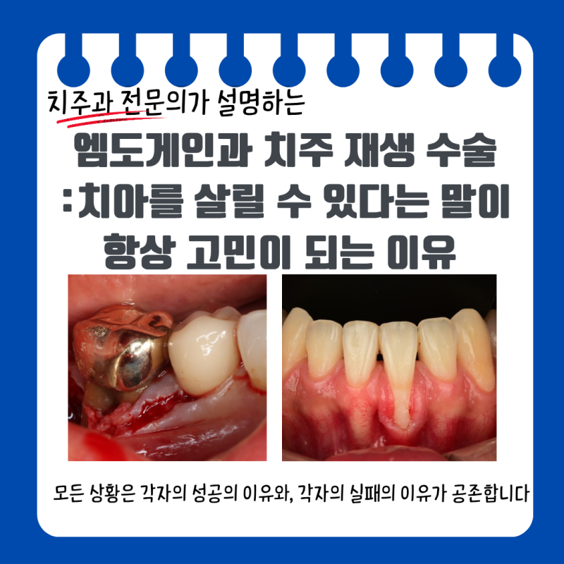 여의도 치주과 전문의 - 치주 재생 수술의 딜레마: 왜 우리는 단칼에 '된다, 안 된다'를 확답....