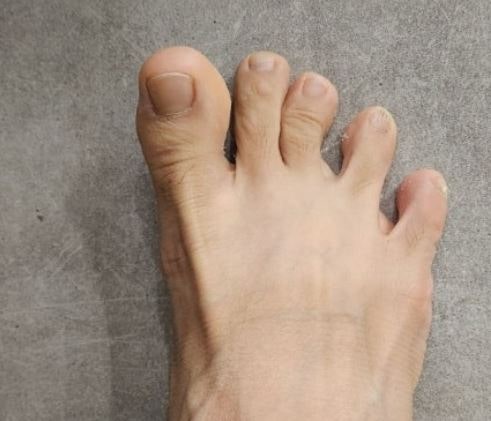 “엄지발가락 끝만 유독 저린 이유” 발에서 시작되는 신경 압박과 허리 문제 구분법
