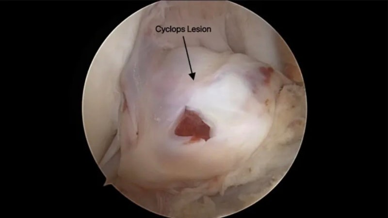 [십자인대 재건술] 핀제거수술 언제, 누가 필요할까? Cyclops lesion??