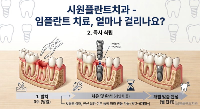 임플란트, 몇 개월이면 끝날까요? 은평구 임플란트 치료 기간 총정리