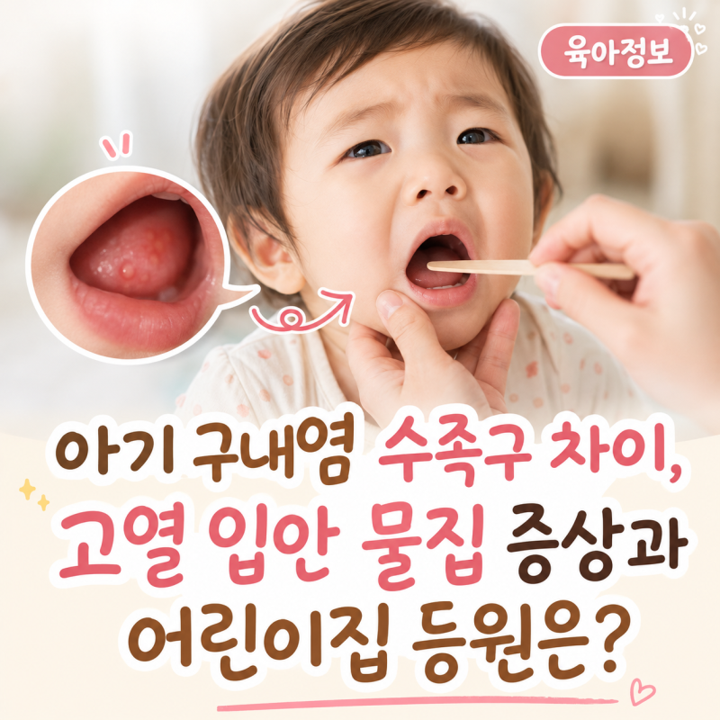 아기 구내염 수족구 차이, 고열, 입안 물집 증상과 어린이집 등원은?