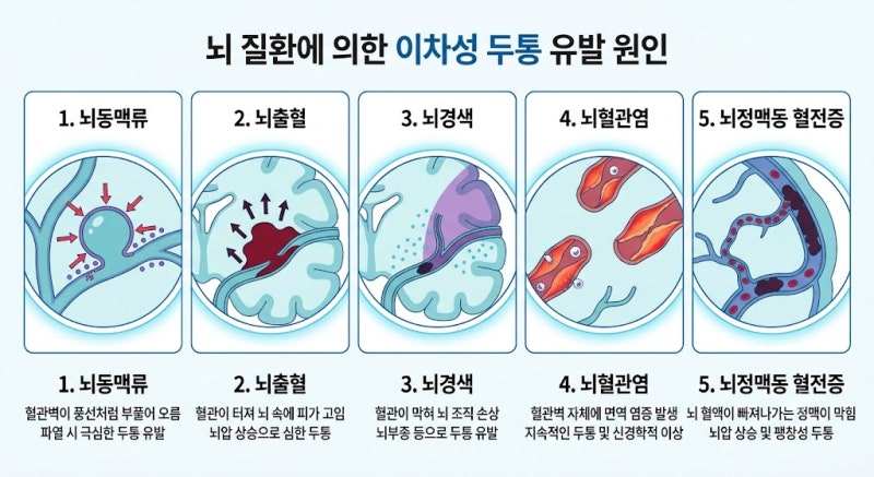 광주 두통 / 머리아픈데 MRI, CT 찍어봐야 하나요 ?