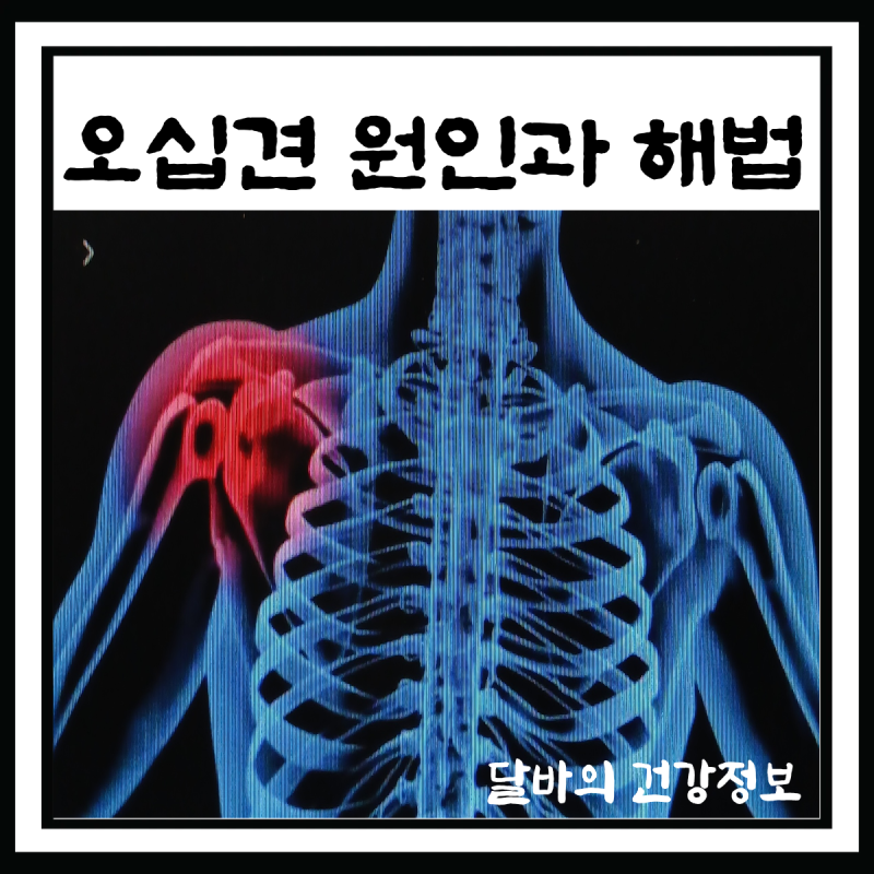 오십견(동결견)원인과 증상 /좋은 음식 강황, 운동과 솔루션