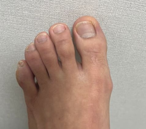 “왜 왼쪽 엄지발가락만 저릴까?” 한쪽에만 나타나는 신경 압박의 흔한 원인
