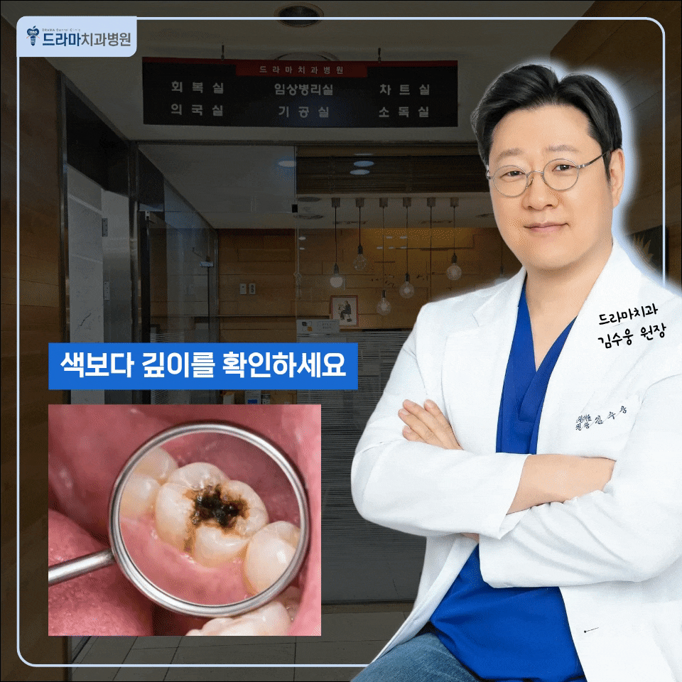 분당충치치료, 까맣게 변한 어금니는 착색과 충치부터 구분하세요