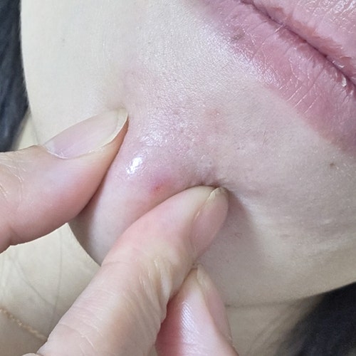 딱딱한 왕여드름 염증주사 통증 대비 효과는? (찐후기)