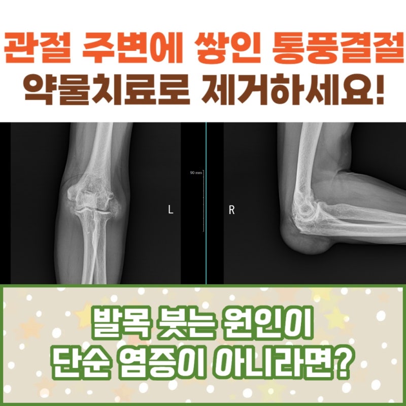 엄지손가락건초염 증상이 반복된다면 자가면역질환을 확인해 보세요