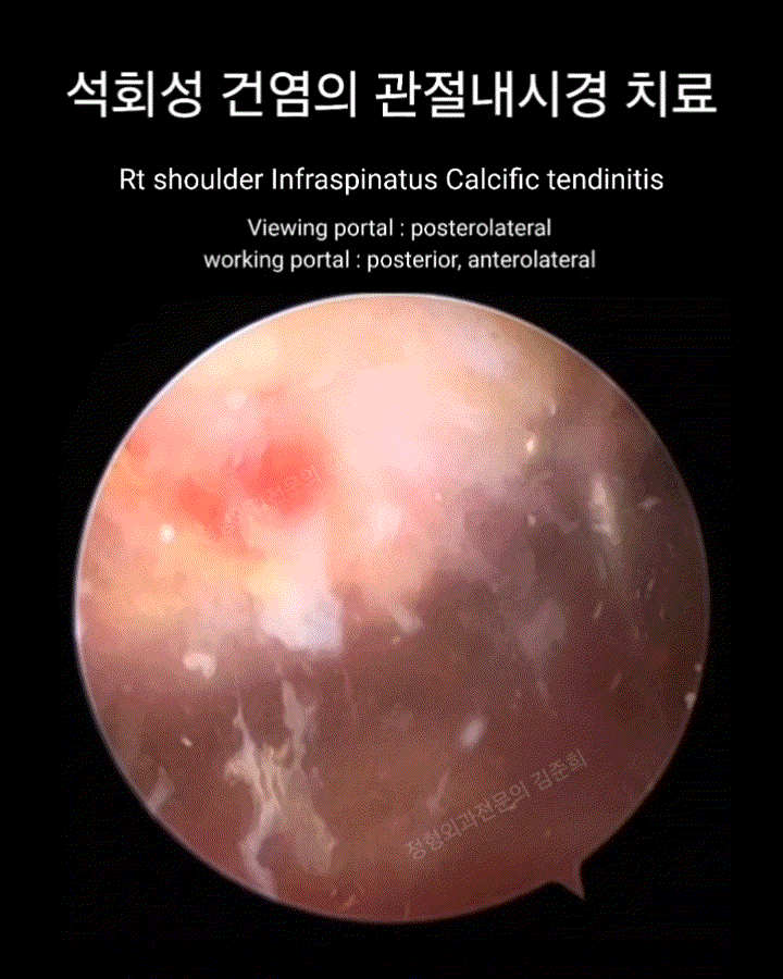 [정형외과 전문의] 어깨 석회성 건염 관절내시경 수술, 숨어 있는 석회를 쉽게 찾는 Technical Ti....
