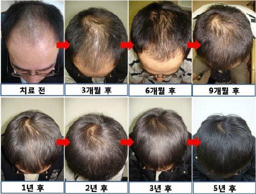 탈모약 건강보험 적용, 어떤 약이 대상일까?…피나스테리드·두타스테리드가 핵심, 미녹시딜....