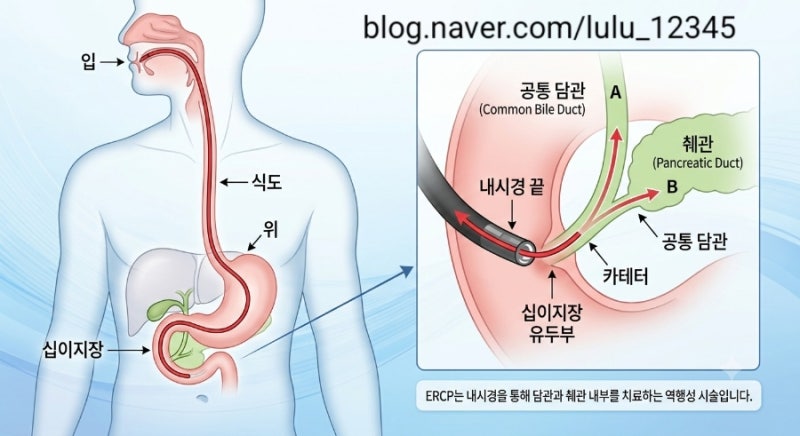30대 췌장암 이겨내기_ ERCP는 무엇인가요?
