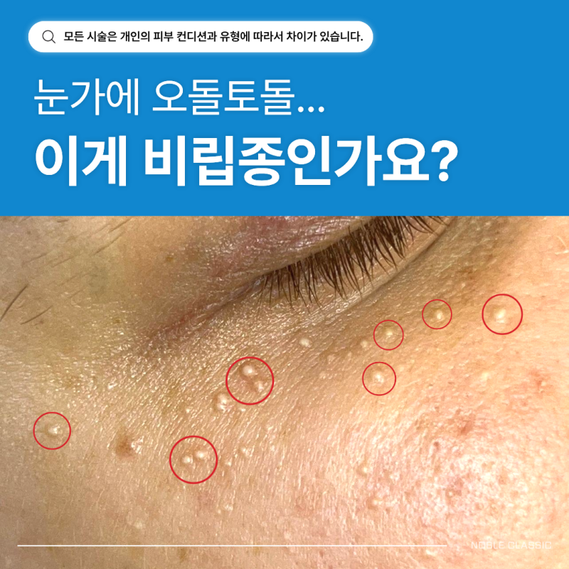 동탄 비립종 제거, 눈가에 좁쌀처럼 올라왔다면?