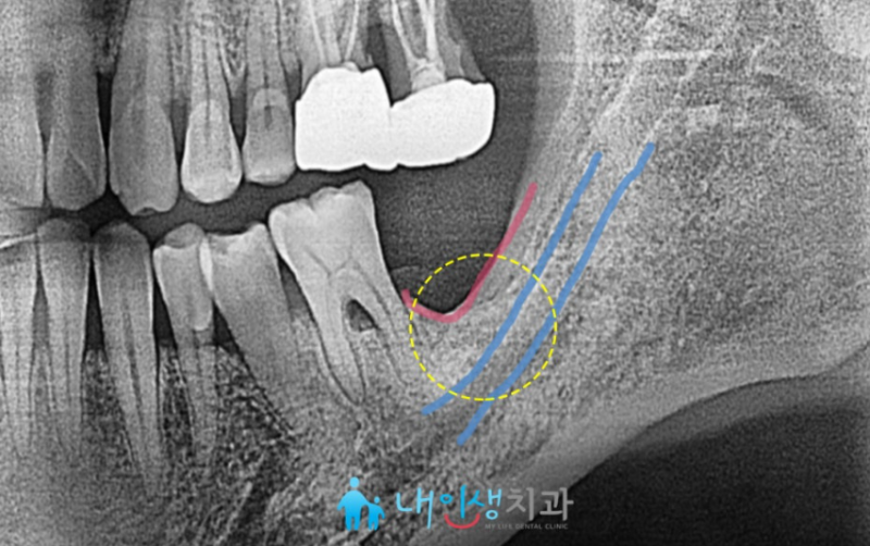 교대역치과, 잇몸주저앉음으로 임플란트를 식립해야 한다면?
