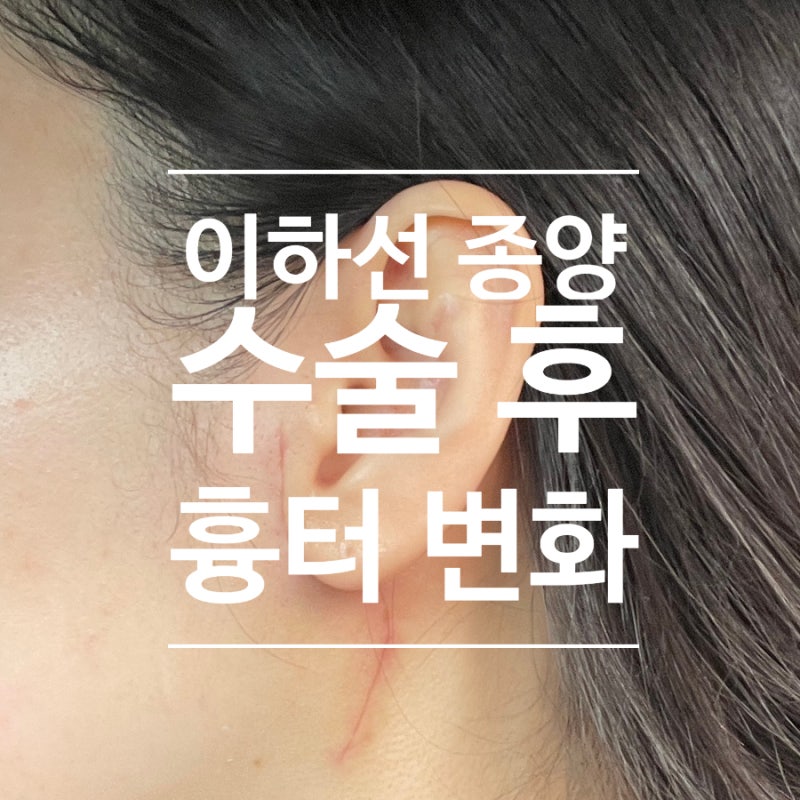 이하선 종양 수술 흉터 레이저 후기, 침샘종양 수술 6개월 후 땡큐서울의원 외래, 브이빔 레....