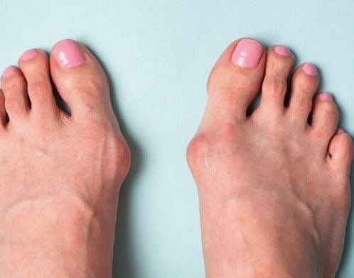 “엄지발가락이 없어지면 걷는 자세는 얼마나 달라질까?” 균형과 추진력에 미치는 영향