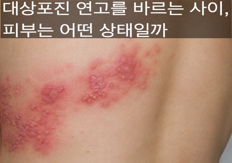 대상포진 연고를 바르는 사이, 피부는 어떤 상태일까?