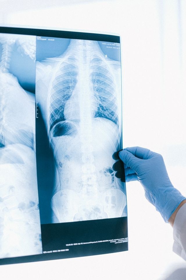 폐암 조기 발견을 위한 저선량 흉부 CT와 일반 X-ray 차이점 분석