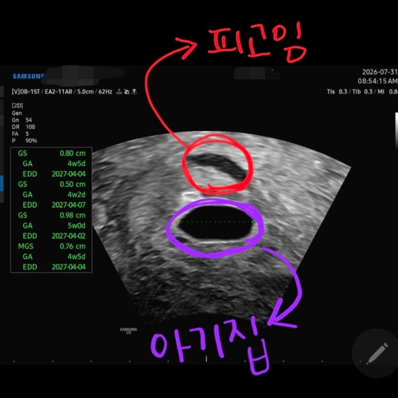 임신5주차 피비침 원인 및 대처법, 문제 없었던 기록(선홍색 피, 질정 처방)