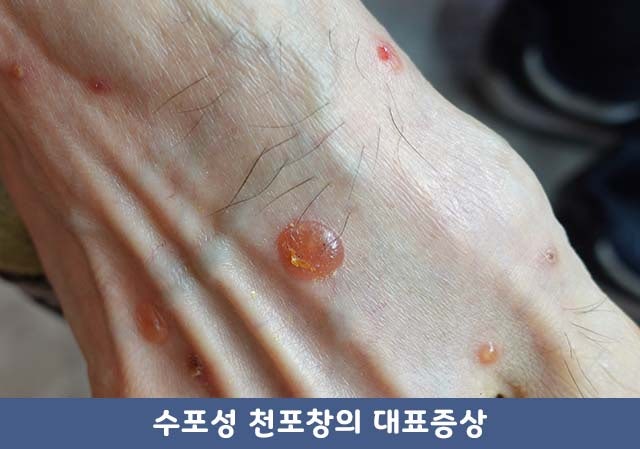 천포창, camscope 피부 소견 및 사진 분석