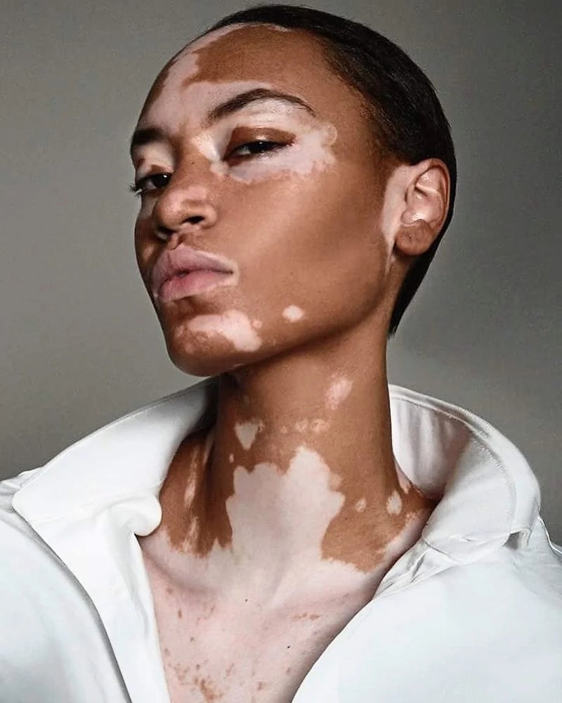 백반증 Vitiligo 은 색소가 부족한 병이 아니었습니다