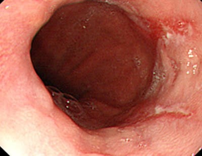 역류성 식도염 Reflux esophagitis/GERD(Gastroesophageal Reflux Disease): “위산이 너무 많아서”만은 아닙....